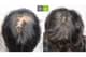 Slider image (7) MOAMAN Hair Transplant Aesthetic Restoration Clinic